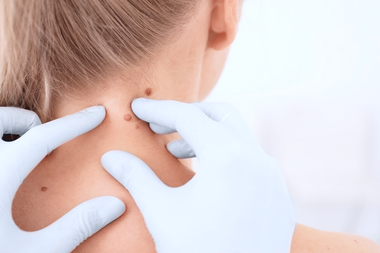 Hautkrebsscreening Muttermal Untersuchung